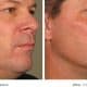before_after_ultherapy_results_full-face11
