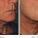 before_after_ultherapy_results_under-chin35